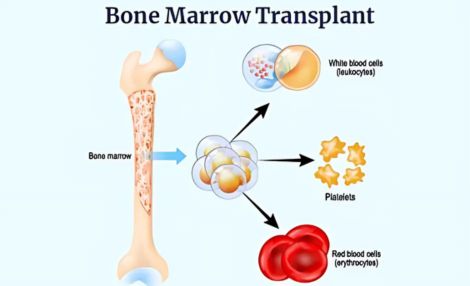 Bone Marrow Transplantation
