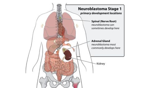 Neuroblastoma by Pediatric Hematologist in India, Dr. Shweta Bansal