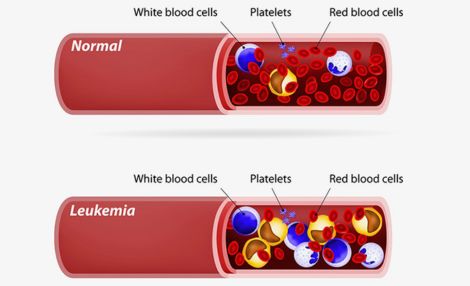 Pediatric Leukemia by Pediatric Hematologist in India, Dr. Shweta Bansal