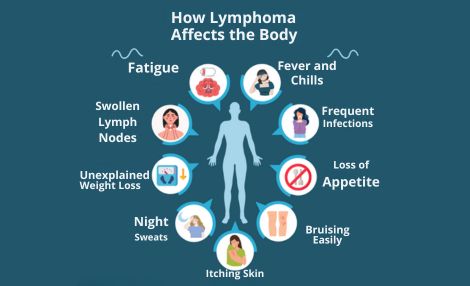 Pediatric Lymphoma by Pediatric Hematologist in India, Dr. Shweta Bansal