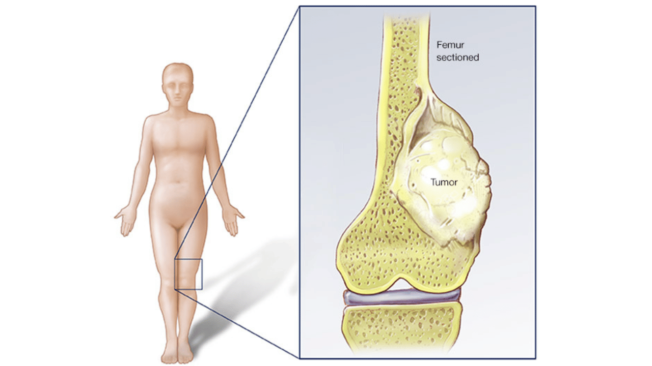 What Are Bone Tumors